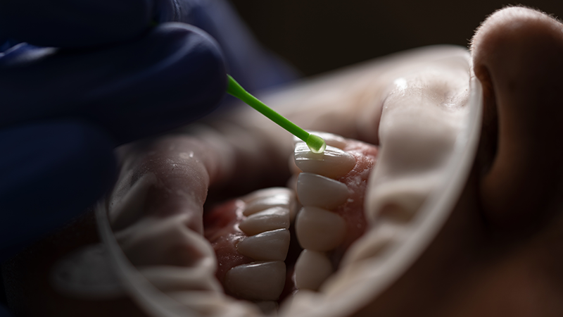 Dental Kompozit Nedir? Ne İçin Kullanılır?